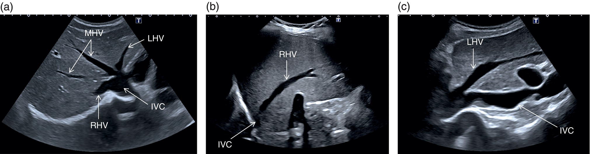 Three radiograph images. a. The hepatic artery, inferior vena cava, right portal vein, common bile duct, and extrahepatic portal vein. b. Right portal vein. c. The left portal vein and inferior vena cava are depicted.