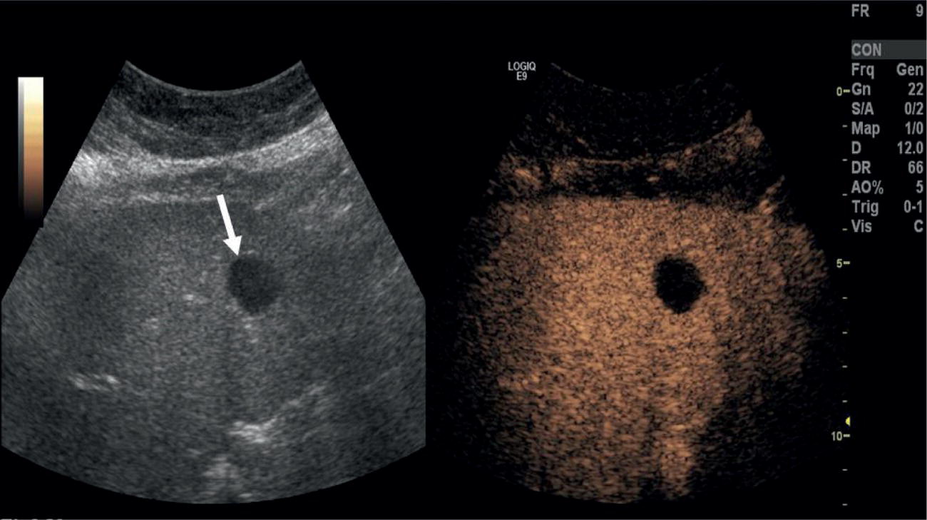 A radiograph images of simple cyst on C E U S. The anechoic thin walled lesion is highlighted with an arrow. The measurements also displayed.