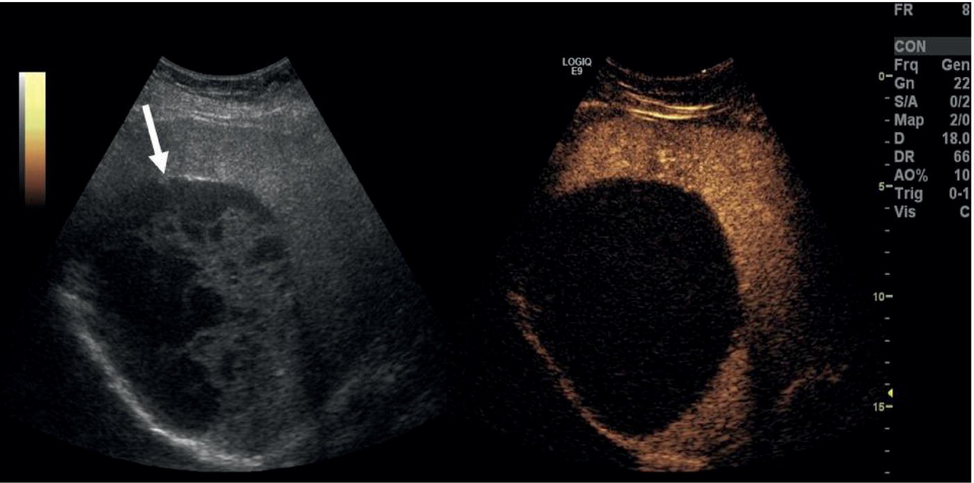 A radiograph image of the complex liver cyst. The cyst is highlighted with an arrow. The septa rim and the internal structure and its measurements are also displayed.