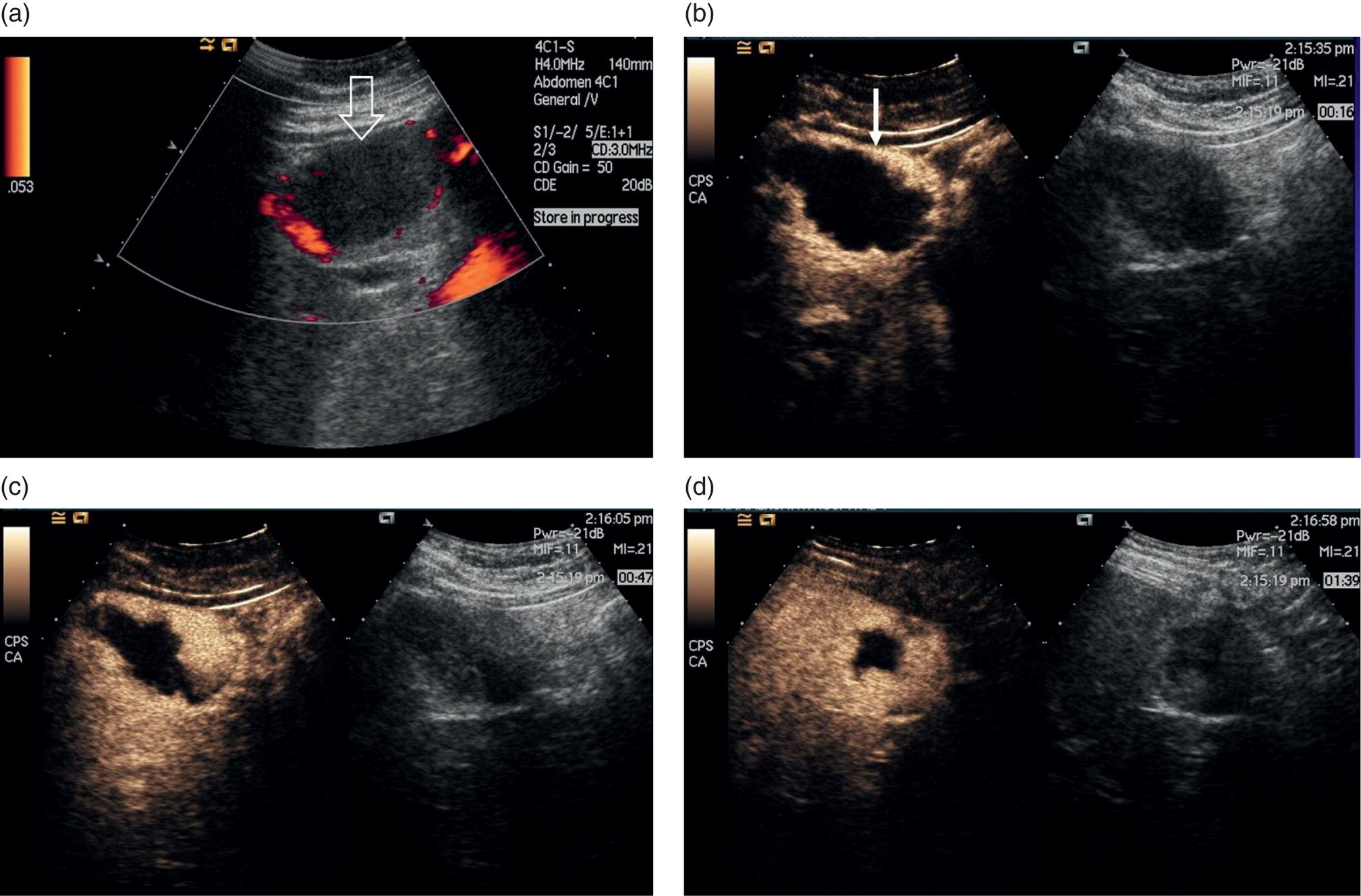 Four radiograph images of haemangioma. It depicts the avascular solid lesion, intravenous sonoVue, globular enhancement with progressive centripetal fill, and its measurements.