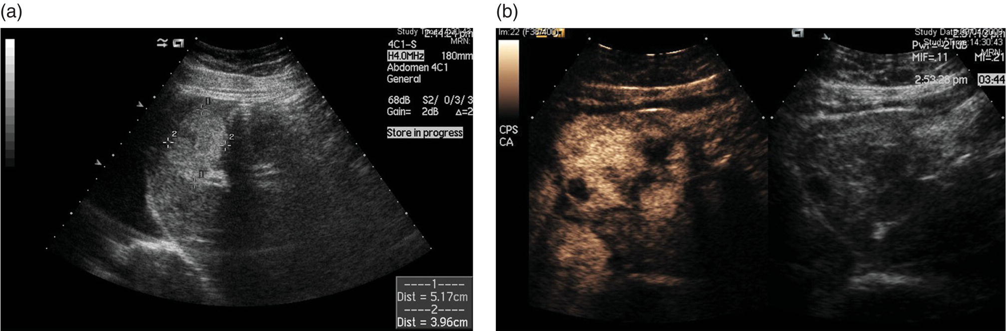 Two radiograph images of haemangioma. It depicts the solid predominantly echogenic lesion, left liver lobe, and intravenous sonoVue. The lesion and its measurements are depicted.