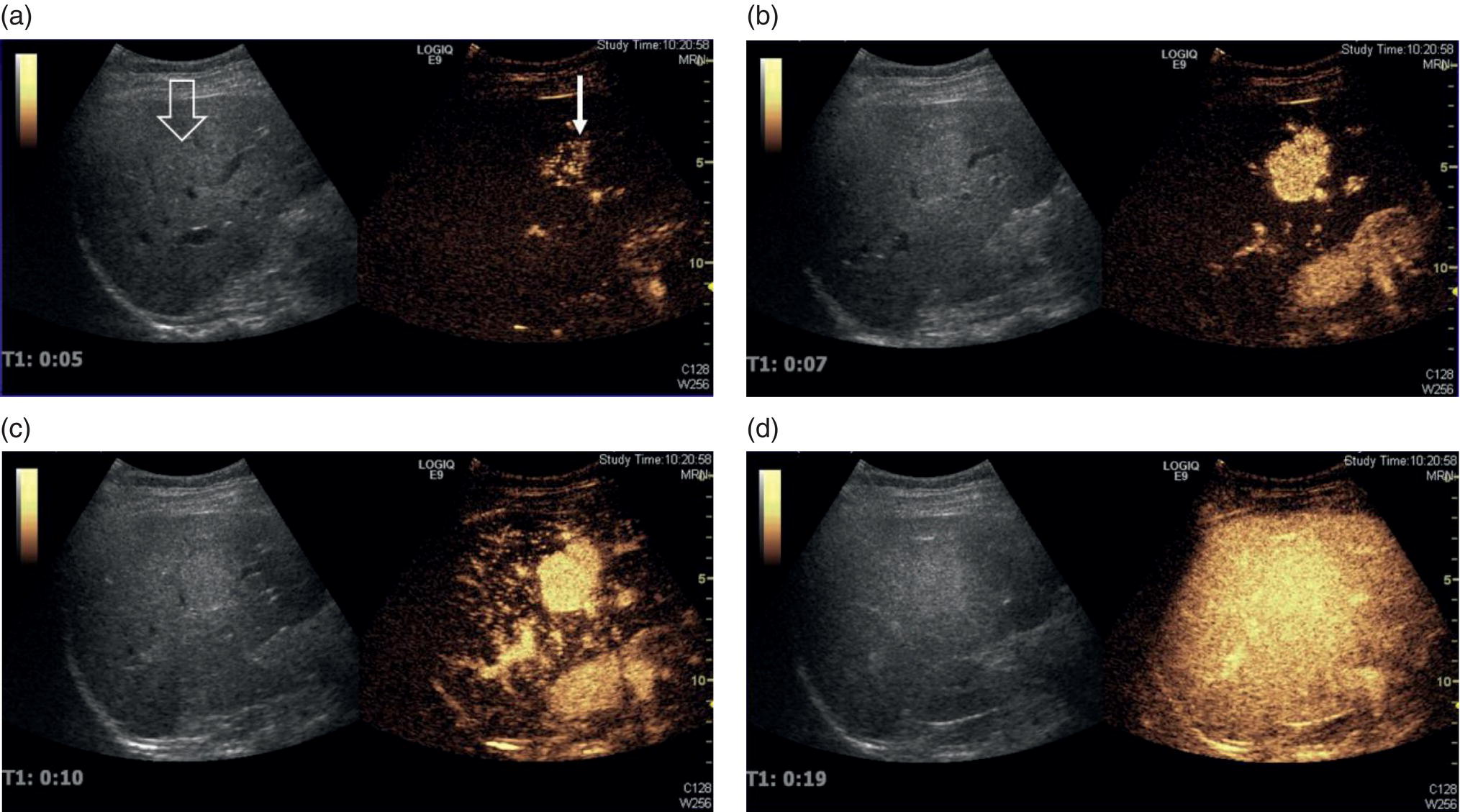 Four radiographs and scan images depict hyperplasia. The focal liver lesion from a central feeding vessel in a spoke-wheel pattern is highlighted with an arrow. The liver lesion and late phase and its measurements are depicted.