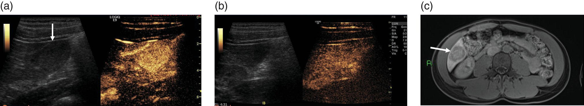 Three radiographs and a scan image of the adenoma. The focal liver lesion is highlighted with an arrow and its measurements are depicted. c. The liver with hepatocytes depicts the defect consistent with an adenoma.