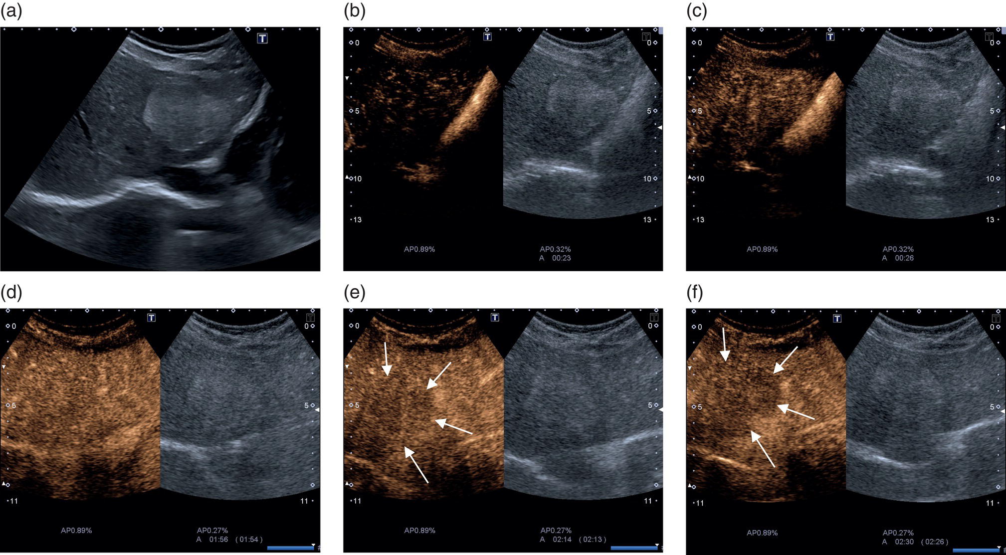 Six radiographs and scan images. The large hyperechoic focal lesion on B-mode, homogeneous subtle arterial hyperenhancement, portal venus iso-enhancement, and vascular phase are highlighted with arrows.