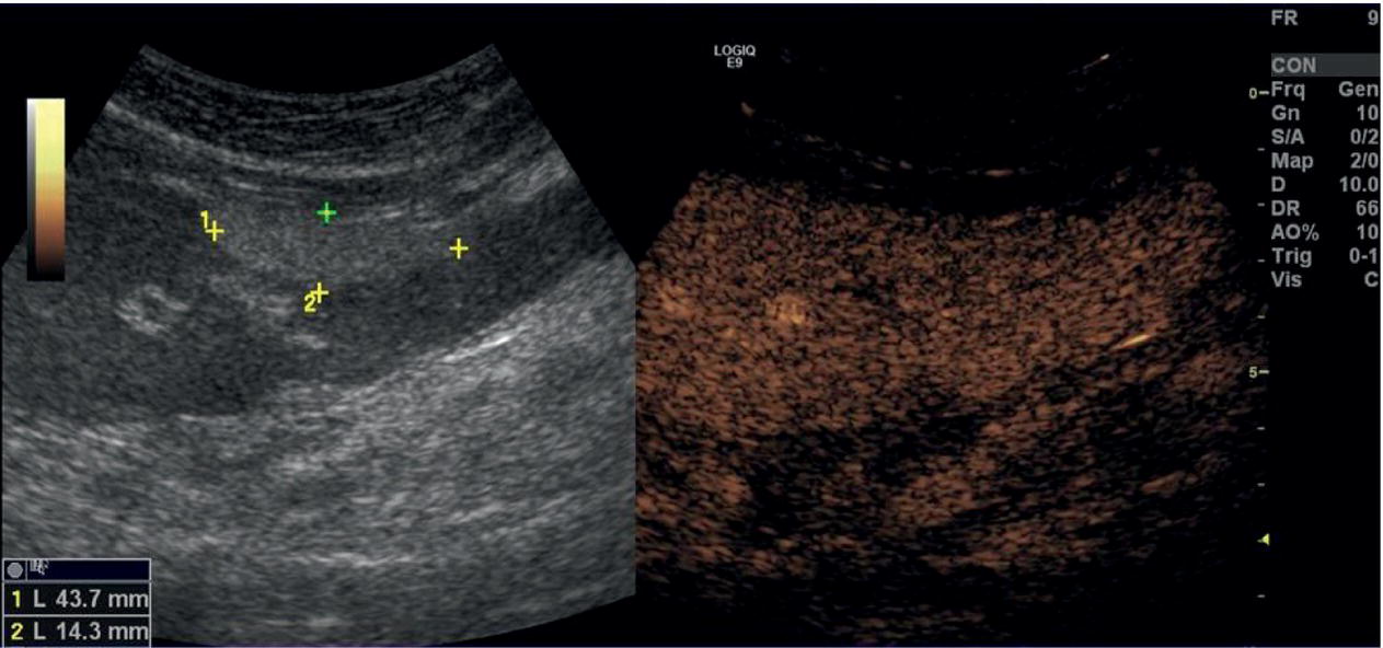 A radiograph image of focal fatty change. The focal liver lesion to the falciform ligament, adjacent liver in all phases, and focal fatty change and its measurements are depicted.