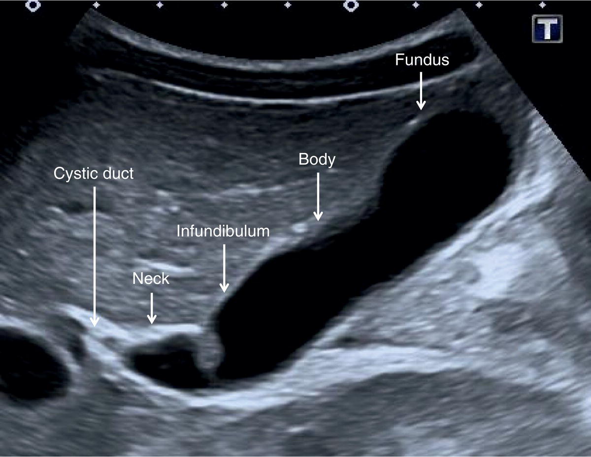 An ultrasound scan image of the gallbladder depicts the fundus, body, infundibulum, and neck are labeled with arrows.