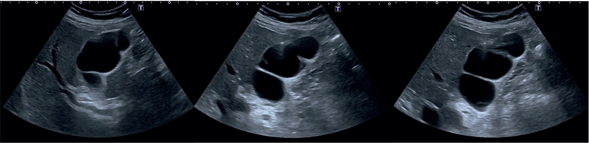 Three scan images of the gall bladder depict the G B present with septations in partial or complete leading to bile stasis and sludge.