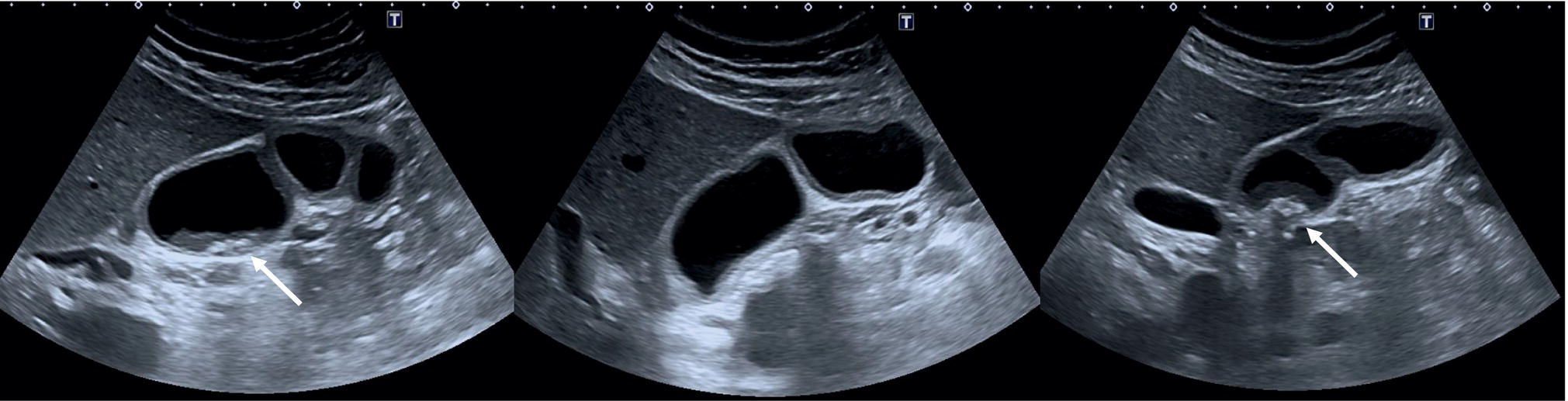 Three scan images of the gall bladder depict the bile stasis, cludge, and stone formation are marked with arrows.