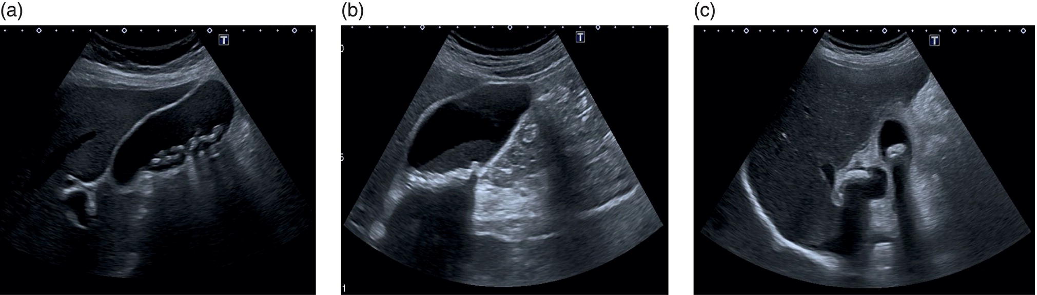 Three scan images depict the different gallstones with posterior acoustic shadowing. The subtle layer of mobile sludge covering small stones in the infundibulum is displayed.