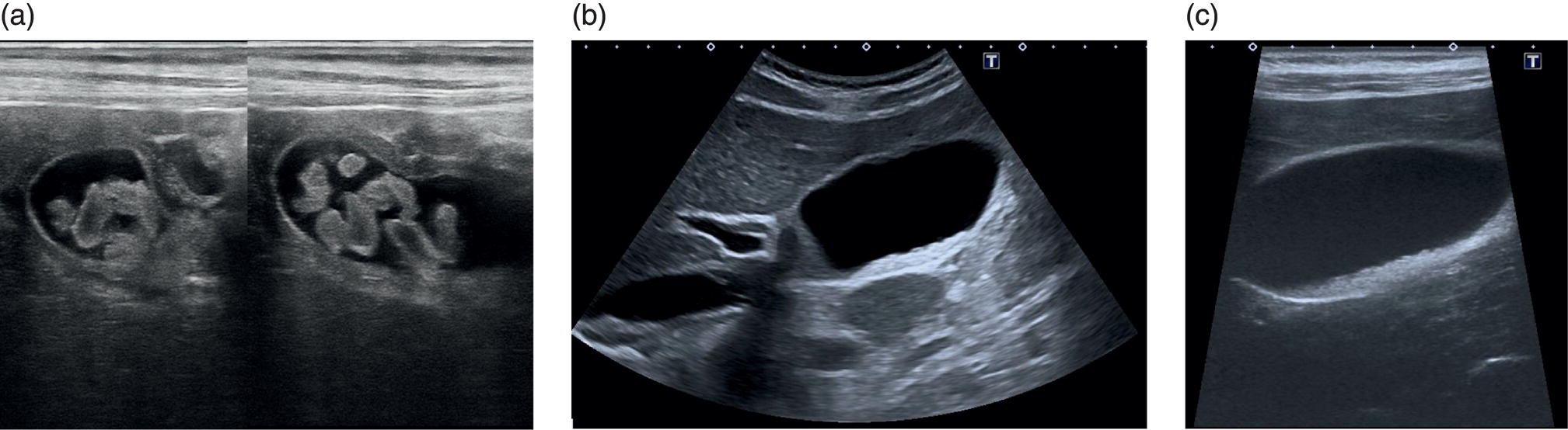 Three scan images depict the gall bladder willed with cholesterol stones with no acoustic shadowing and a layer of small stones without shadowing along the posterior wall of the gall bladder.