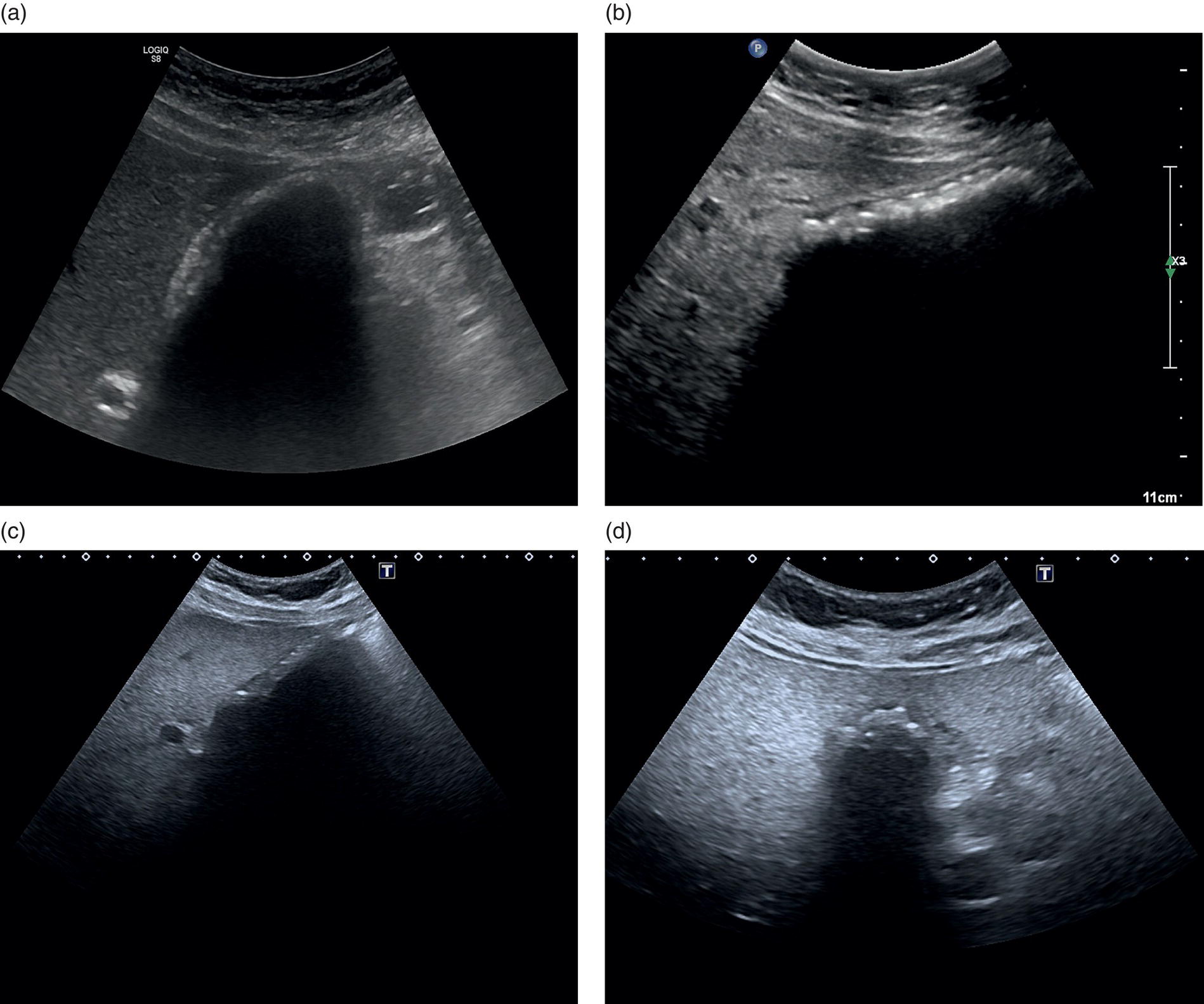 Four scan images depict the porcelain gall bladder, wall-echo shadow, the gallbladder is packed with stones, and the transverse scan view.