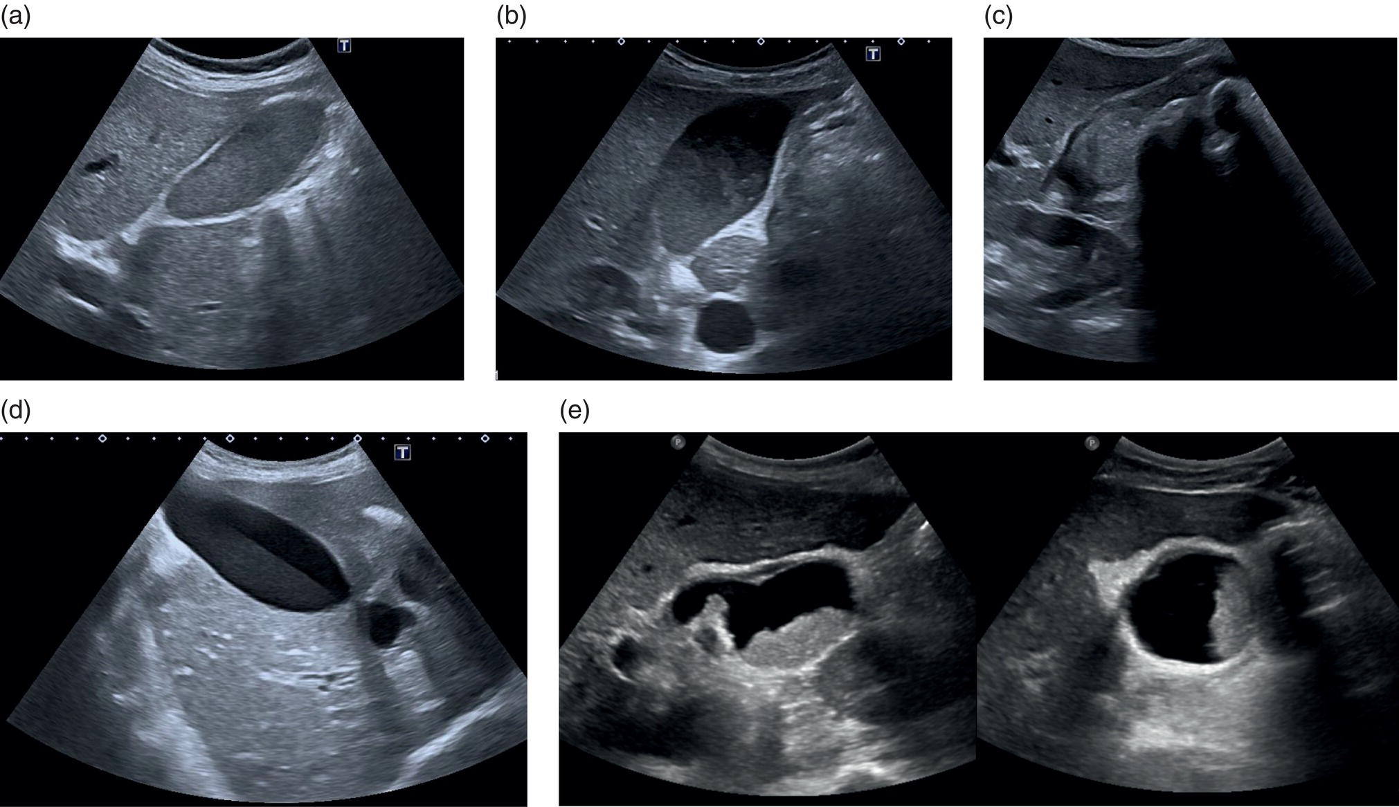 Five scan images depicts the gallbladder filled with sludge, large stones, the sludge and anechoic bile, and solidified sludge to the gallbladder wall.