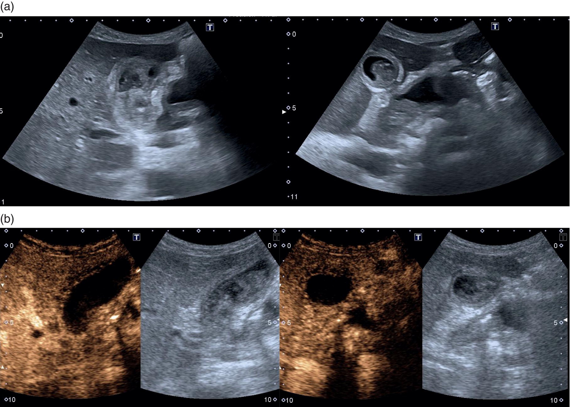 Two scan images of the gallbladder. It depicts the heterogeneous material with the gallbladder wall, the neoplastic growth, and steering towards solidified sludge.