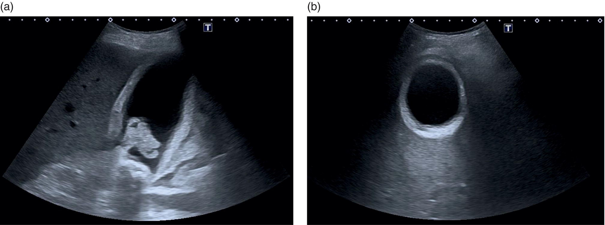 Two scan images depict the acute gallstone cholecystitis and gallbladder wall thickening and solidified sludge and stones in the gallbladder neck.