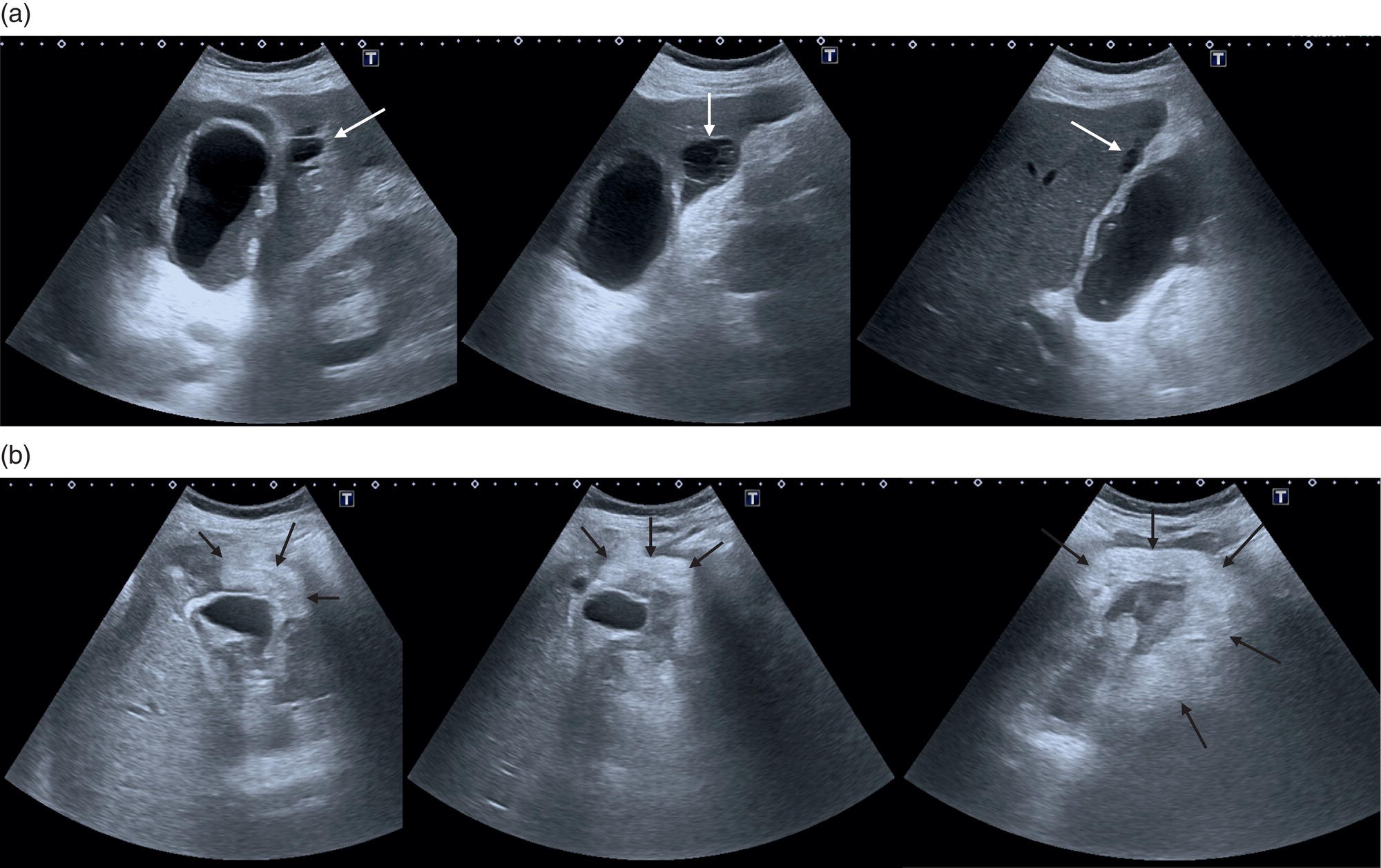 Two sets of scan images depict acute cholecystitis, intraluminal sludge, a thickened gallbladder, pericholecystic collection, hemoglobin drop, G B lumen, and ill-defined hyperechoic material surrounding the gallbladder are depicted.