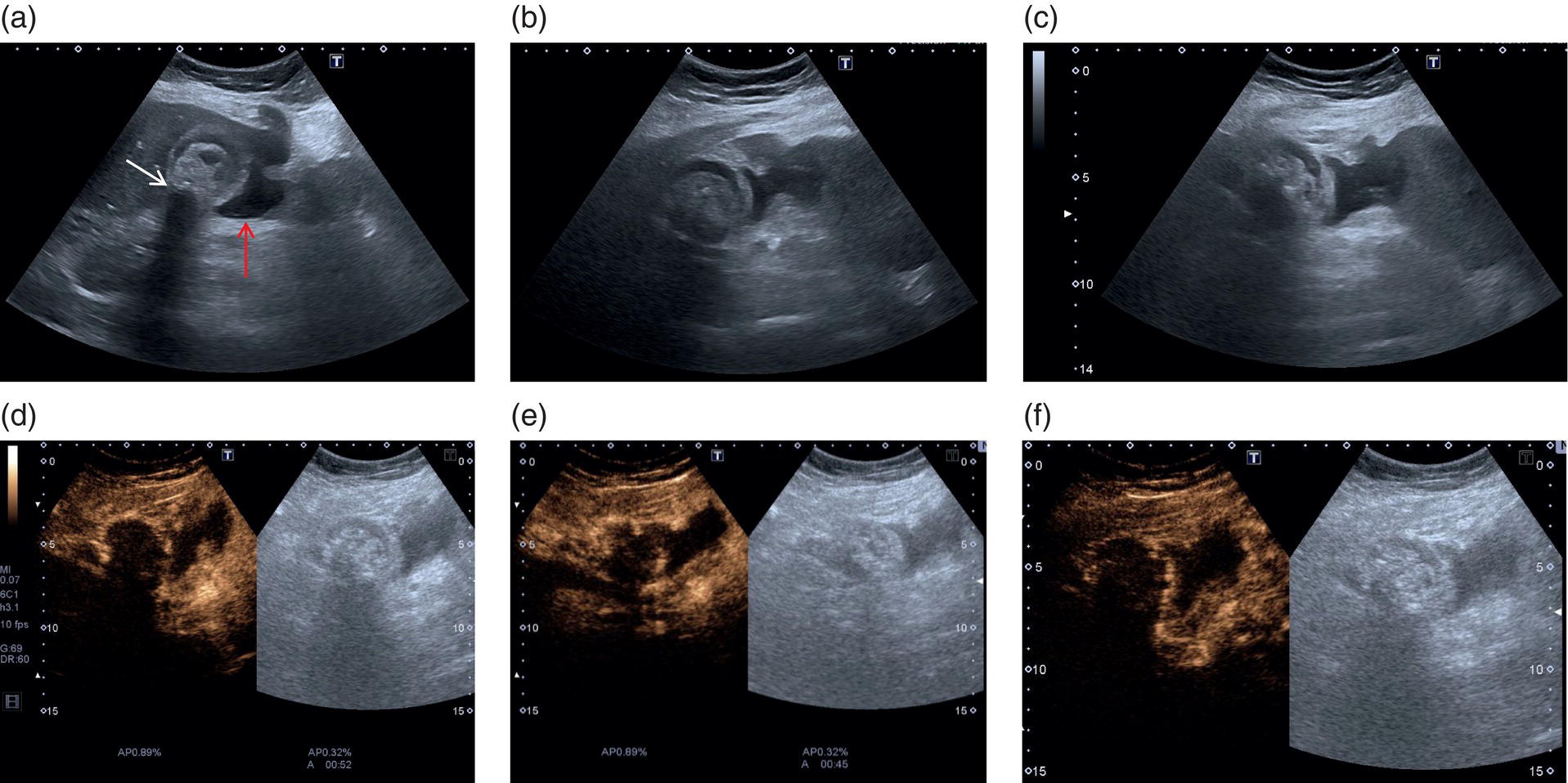 Five scan images depict the thickened gallbladder filled with heterogeneous material and stone, pericholecystic collection to the left liver lobe, and integrity of the gallbladder with leakage.