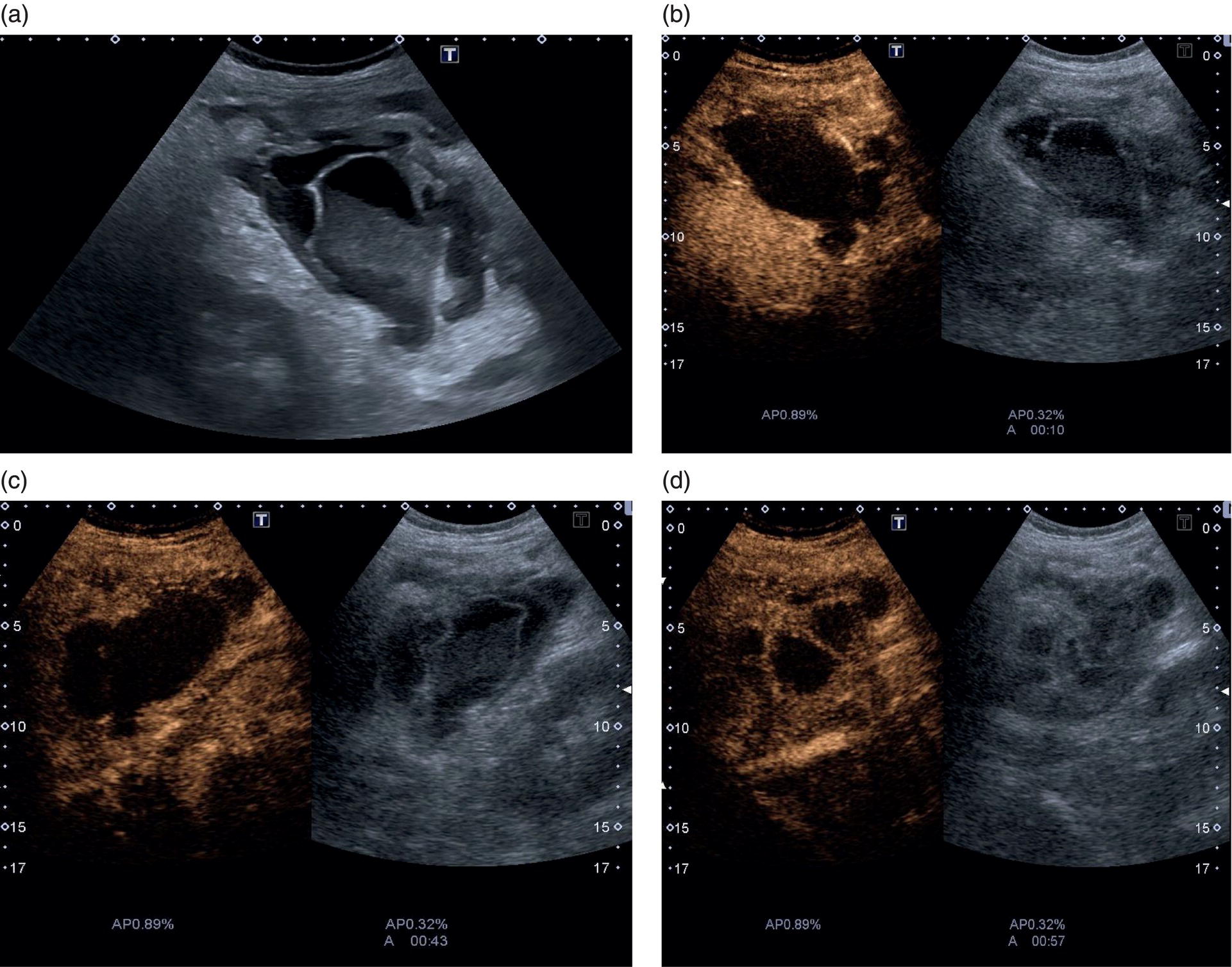 Four scan images of gangrenous cholecystitis. The gallbladder lumen with heterogenous material, layer between the lumen and circumferential collection, necrotic, and loculated at the level of the fundus are depicted.