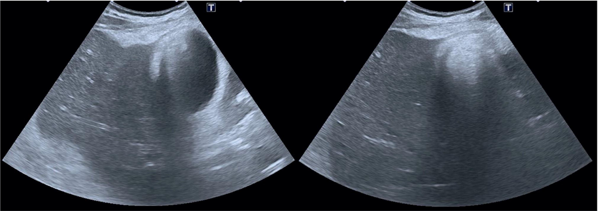 An ultrasound scan image of the gallbladder depicts the reverberation artifacts rising from the gallbladder wall and the fundus.