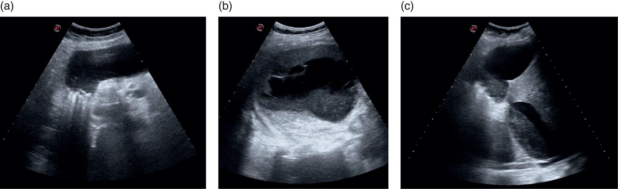 Three scan images depict the multiple small stones in the gallbladder neck, anechoic and echogenic content, and debris, aligned and in direct continuity with the gallbladder neck.