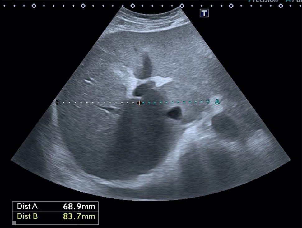 An ultrasound scan image showing the morphological appearance of the 
liver. At the bottom dist A 68. 9 millimeters and dist B 83. 7 millimeters are indicated.