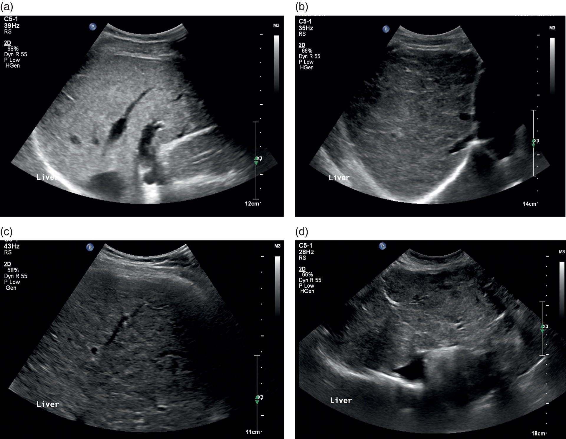 Four ultrasound scan images showing heterogenic echotexture of liver parenchyma of different grades of severity. The images are titled as follows. 1. Mild. 2. Moderate severe. 3. severe. 4. Severe with an extremely heterogenic echotexture and a mixed macronodular pattern.