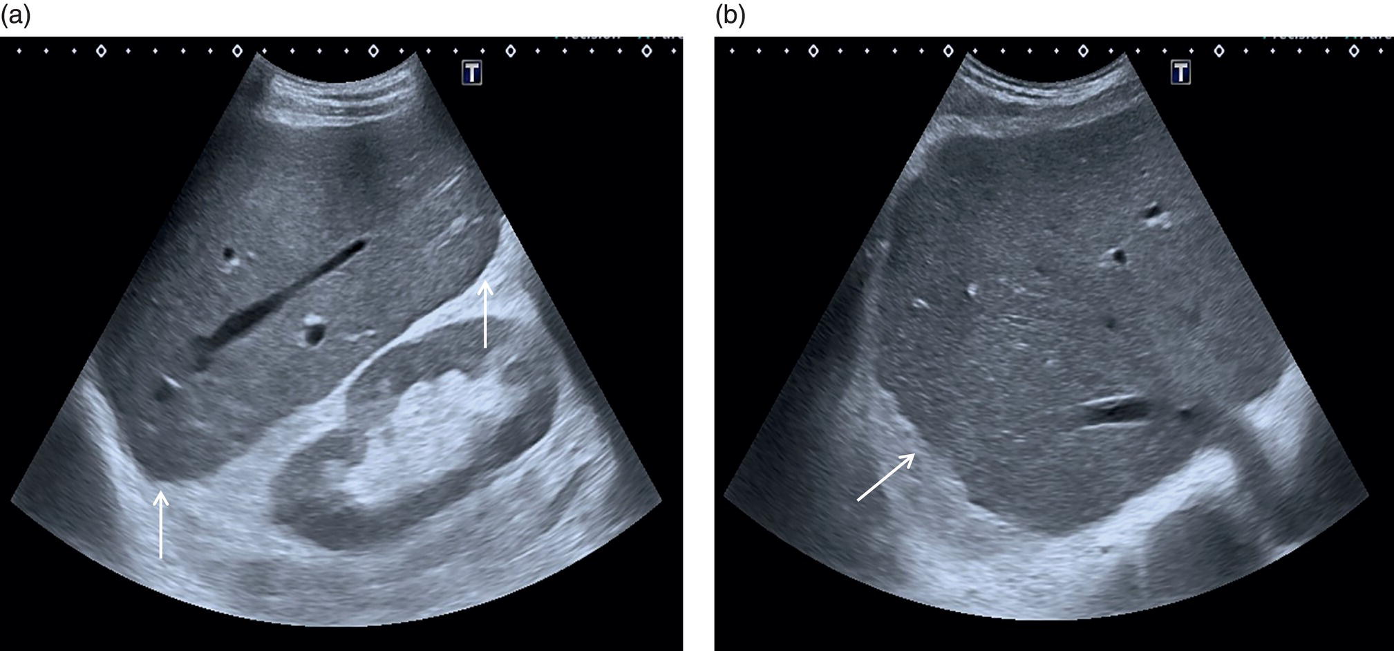 Two ultrasound scan images show advanced liver disease. The outline of the liver is irregular and nodular, with less distinct and rounded margins are indicated using arrows.