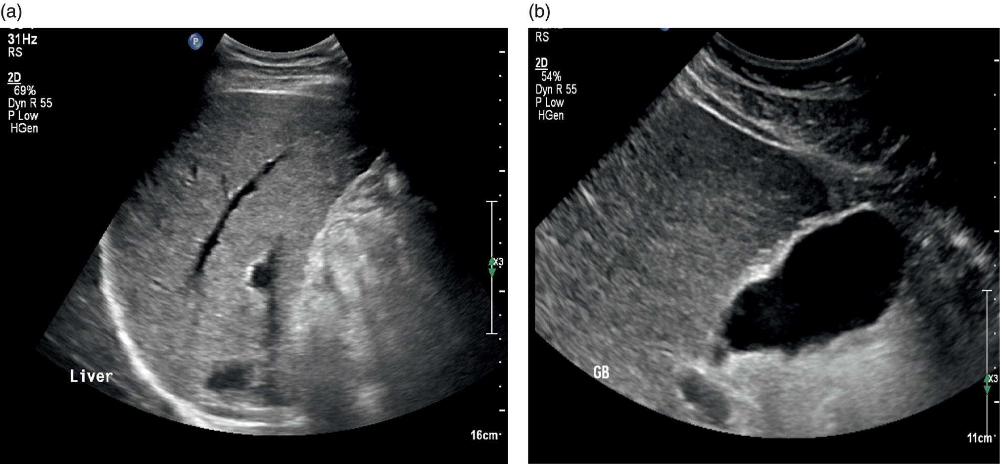 Two ultrasound scan images showing the parenchymal retraction and nodularities. By exploring the contour of the veins and gall bladder they are highlighted.