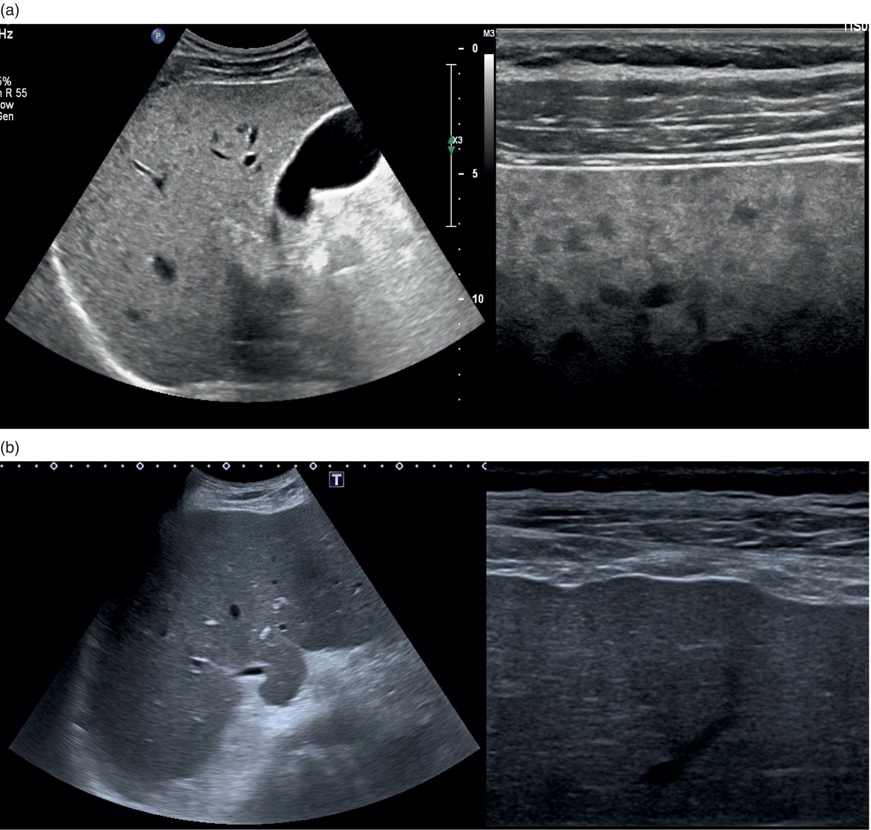 Two ultrasound scan images showing parenchymal micronodularities. The outlines are iregular and they are highlighed by magnifying the surface. The magnified images are at the right.