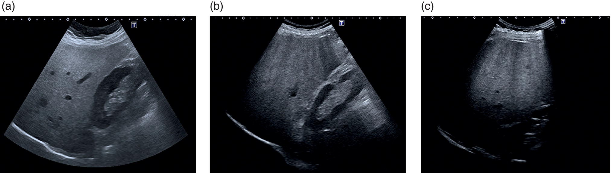 Three ultrasound scan images. The images are labeled grade 1, grade 2, and grade 3 according to their brightness and the degree of posterior attenuation. The grade 1 image is clear when compared to the other two images.