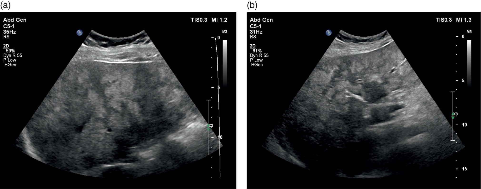 Two ultrasound scan images depicts the diffuse ill-defined hepatic steatosis with a geographical pattern of distribution.