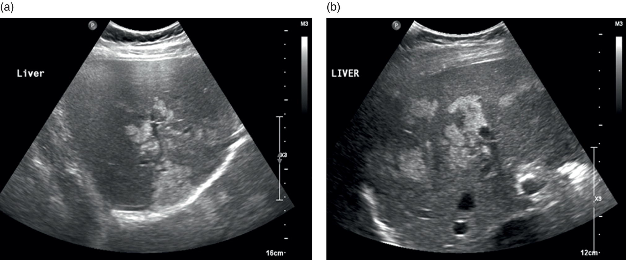 Two ultrasound scan images of the liver. The images are more focal but ill-defined distribution of hepatic steatosis. It has no capsular or vascular distortion.