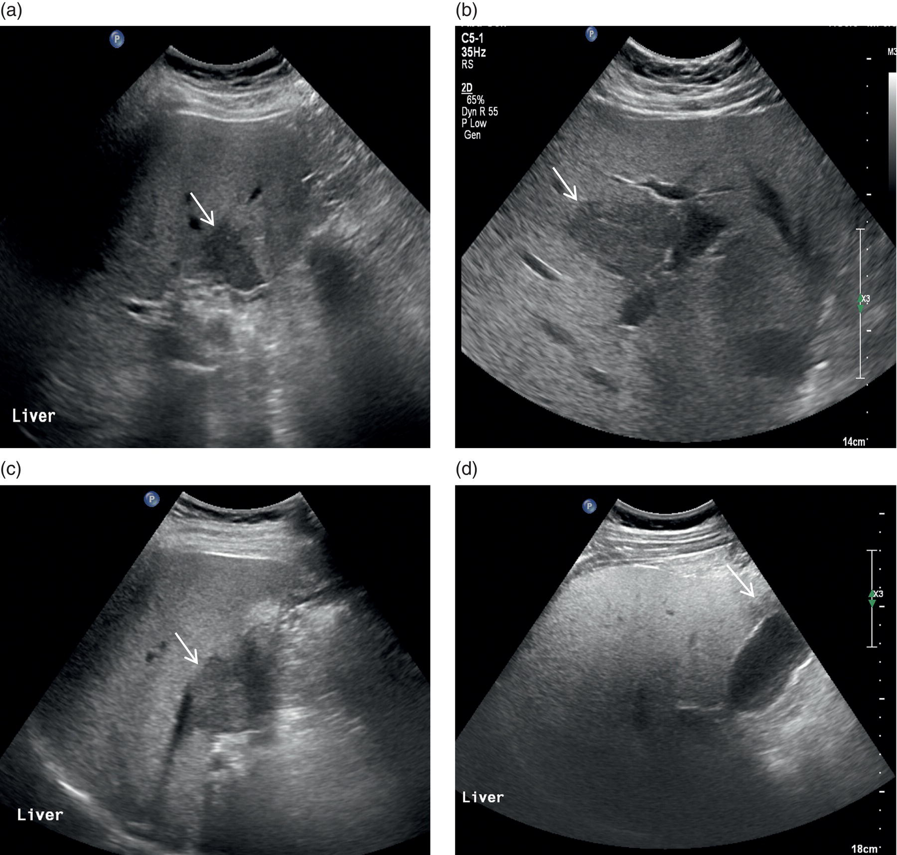 Four ultrasound scan images of the liver. The focal fatty sparing is denoted using arrows. They are adjacent to the portal vein.