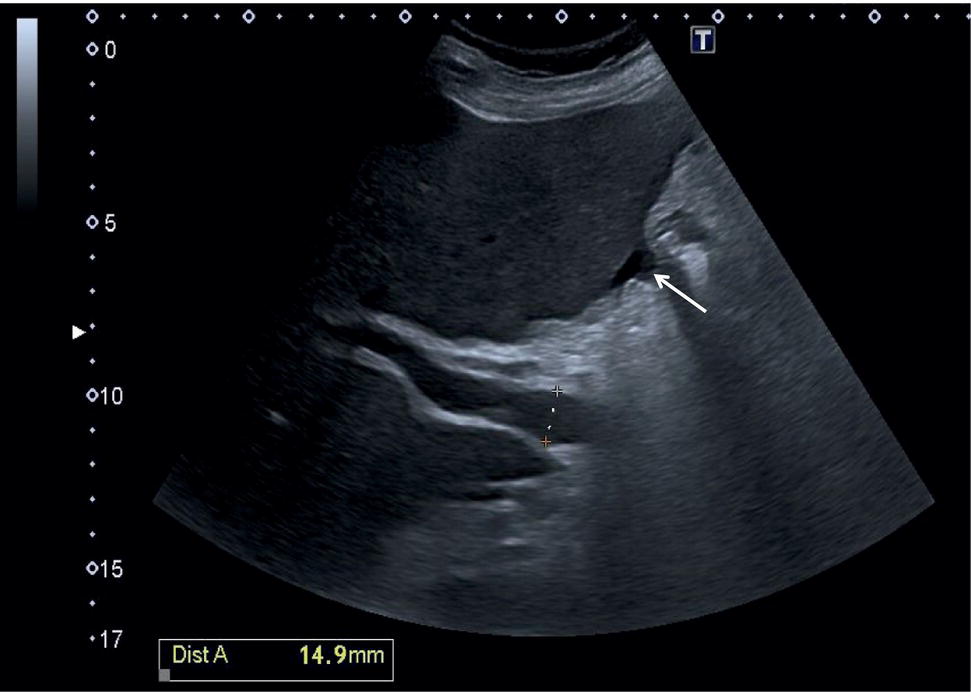 An ultrasound scan image depicts the Dilated portal vein in a patient 
with advanced liver disease. It is highlighted using arrows. The dual A 14. 9 millimeters is indicated.