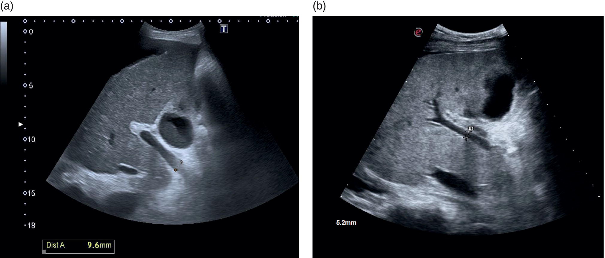 Two ultrasound scan images of two patients with chronic liver disease. It depicts an irregular outline but with a relatively small portal vein.