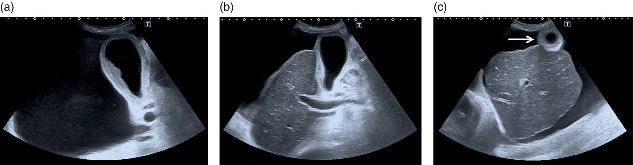 Three ultrasound scan images of gall bladder. Advanced liver disease is revealed by parenchymal or capsular retraction, irregular outline, ascites, and GB thickening.