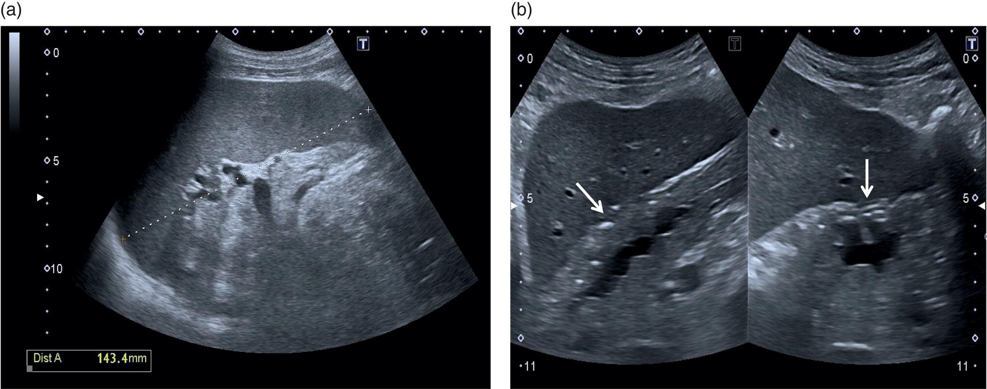 Two ultrasound scan images. 1. Homogeneous splenomegaly. 2. Two scans one is the thick-walled stomach in longitudinal at the left and the other is a transverse section at the right.