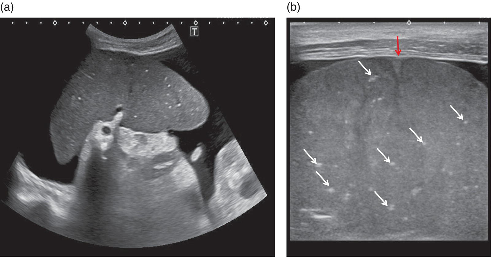 Two ultrasound scan images depicts the cirrhosis and severe portal hypertension. a. The spleen is surrounded by abundant ascites and hyperechoic spots are scattered throughout the splenic parenchyma. b. The maginified image is shown to reveal the irregularities of the splenic profile.