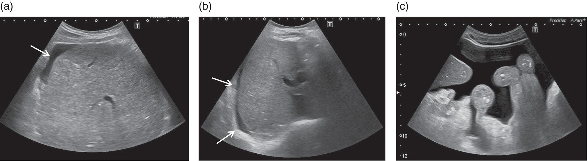 Three ultrasound scan images depicts the small-volume ascites surrounding the liver and large-volume ascites in which oedematous 
small bowel loops are seen floating