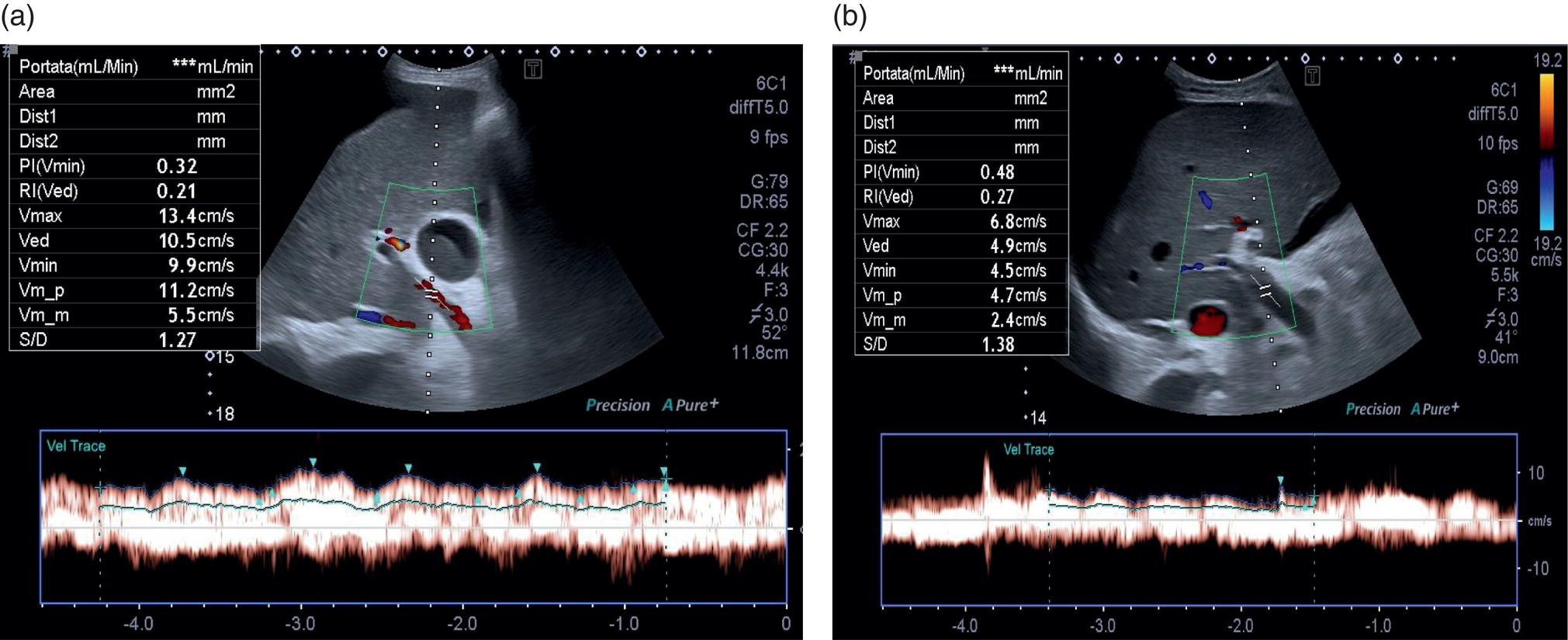 Two screenshots of an ultrasound scan with their respective graphs are below. 1. Colour Doppler reveals a very slow hepatorenal flow. 2. There is no detectable color signal.