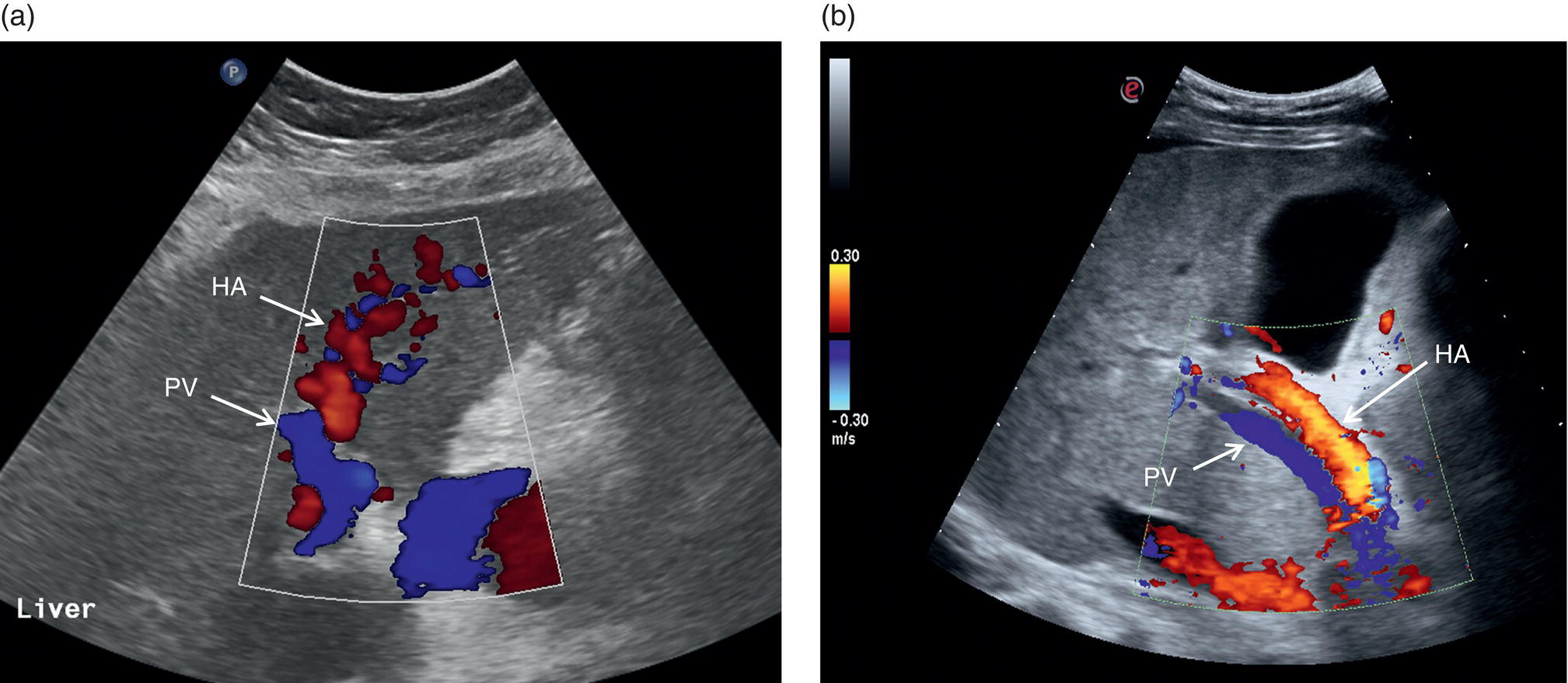 Two ultrasound scan images of portal blood flow inversion as an expression of severe portal hypertension. The H A and the P V are indicated using arrows.