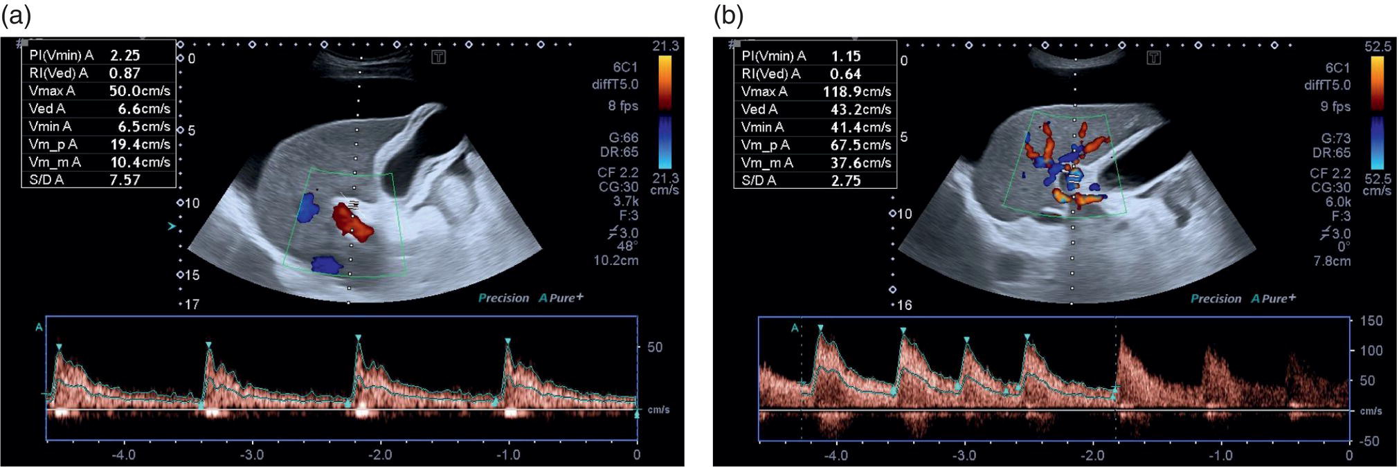 Two screenshots of ultrasound scan images. 1. Increased hepatic resistive index in a patient with advanced cirrhosis. 2. High peak systolic velocity.