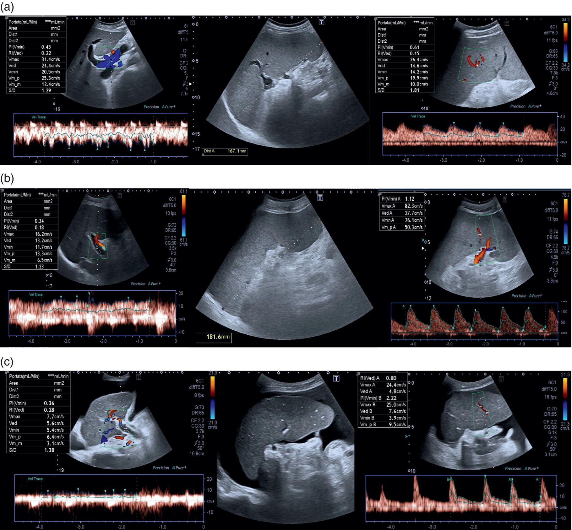 Three ultrasound scan images. 1. Normal portal flow velocity, splenomegaly, and normal splenic pulsatility index. 2. Cirrhosis with reduced portal flow velocity and splenomegaly with an increased splenic. 3. Another case with cirrhosis, ascites, very slow portal venous flow, no sign of splenomegaly, but the PI is very high.