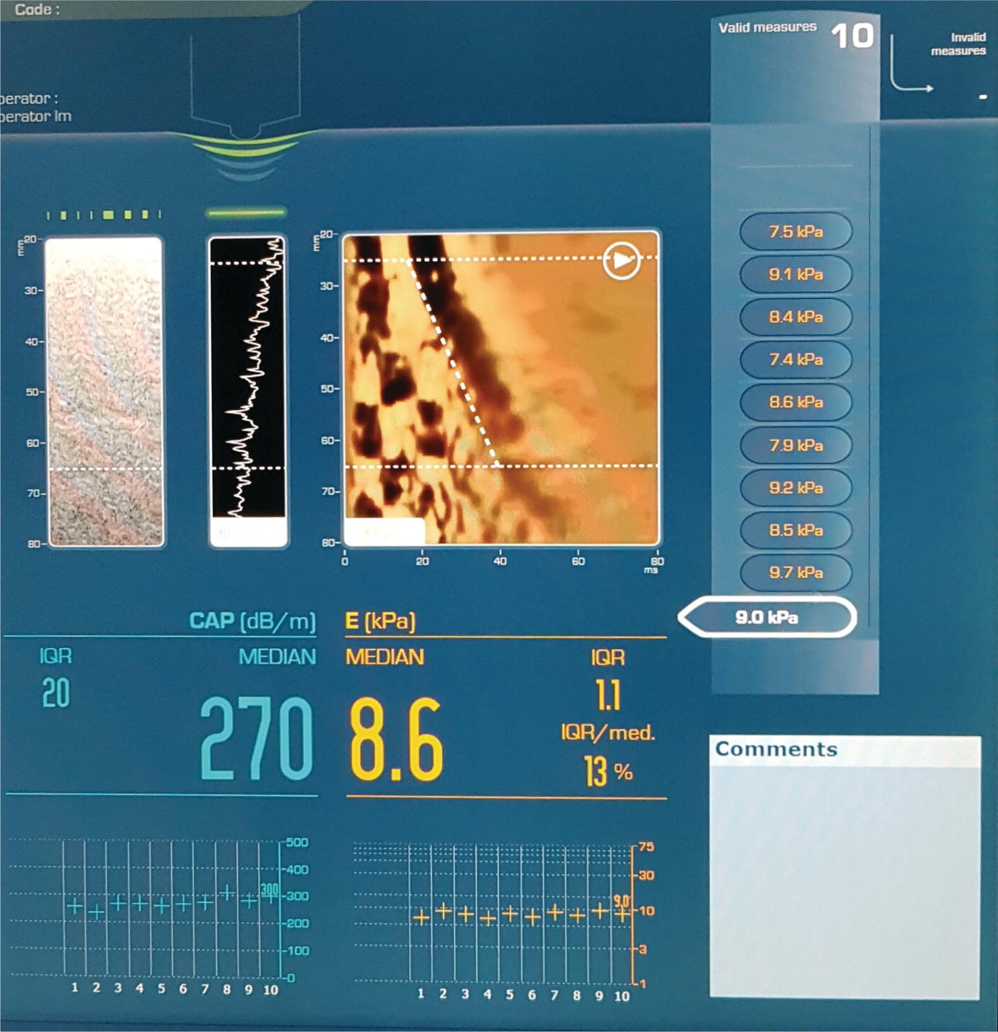 A screenshot shows the transient elastography readings. The measurements are displayed on the monitor. It also includes the interquartile over median ratio, attenuation of the ultrasound beam, median C A P value, and shear wave propagation speed.