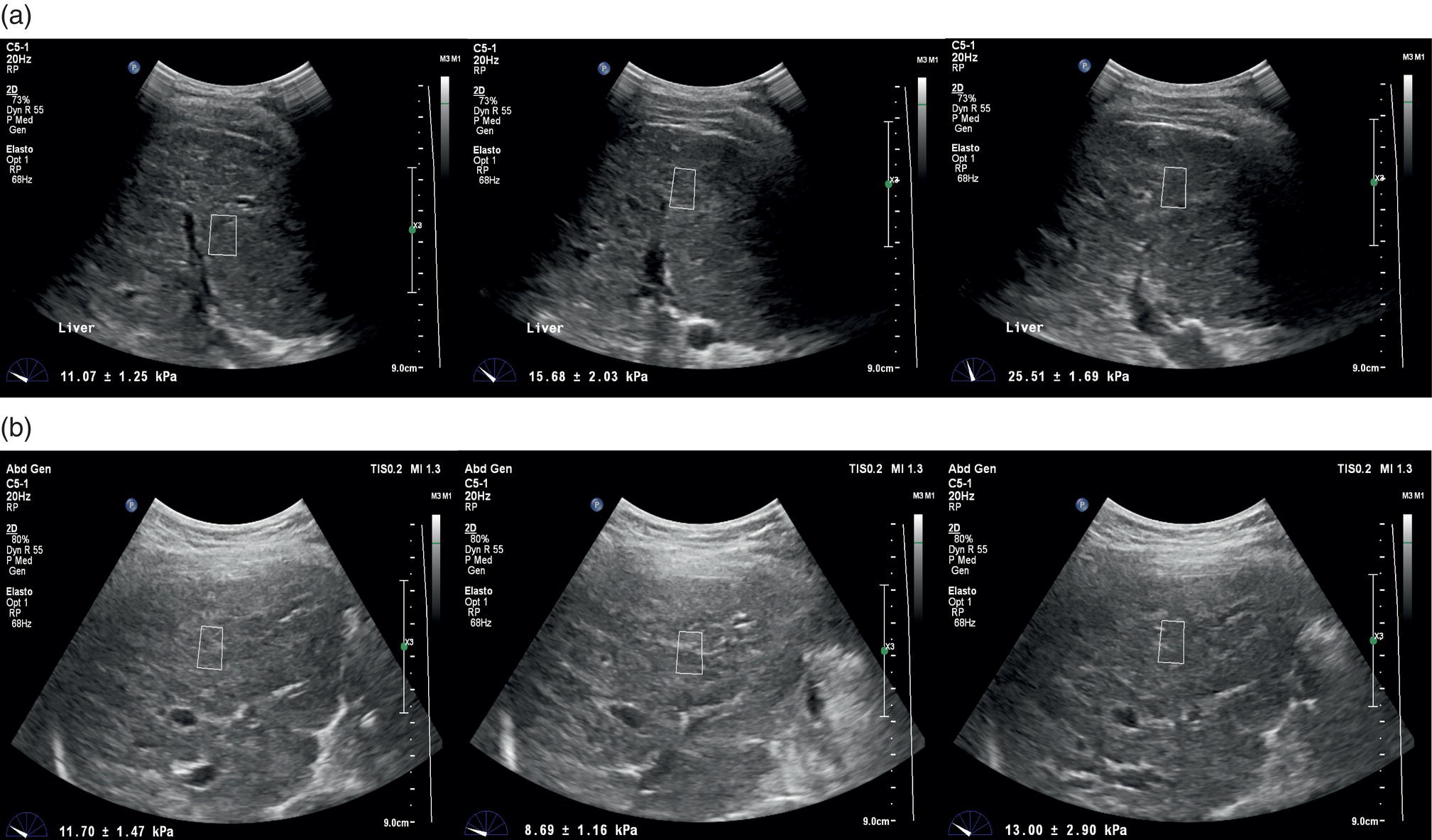 Two sets of ulstrasound images depict the cases of primary biliary cholangitis–related chronic liver disease. (a) Liver stiffness measured by point shear wave elastography reveals high stiffness results, which however are very variable secondary to the uneven surface of the liver parenchyma. (b) Nodularities and heterogeneity of the liver parenchyma are even more pronounced in the second case, which is an example of advanced cirrhosis in which L S results are lower than expected.