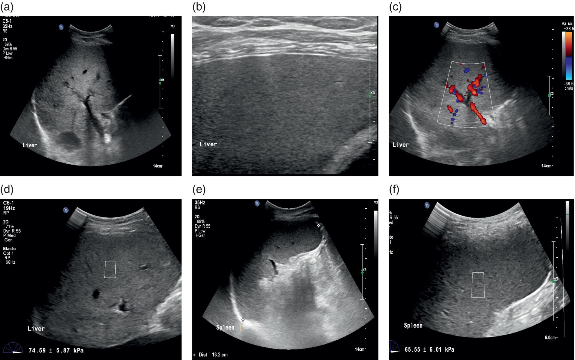 A set of four ultrasounds, one elastography, and one color Doppler image of an old female patient affected by chronic liver disease. A. A stetotic liver with a lot of fat content. B. Smooth and uniform texture.c. Arterial buffering in portal vein displayed on color doppler. d. High rigidity with 74 kilopascal. e. Bipolar diameter of spleen is 13.2 centimeters. f. Stiffness testing at 64 kilopascal.