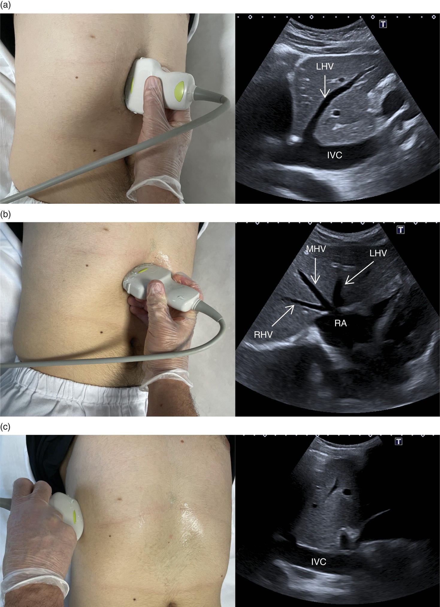 A set of three photographs of a patient under medical checkups and the relevant three ultrasounds. A. Display of the right atrium, subcostal approach. B. It displays three hepatic veins. C. Intercostal coronal approach.