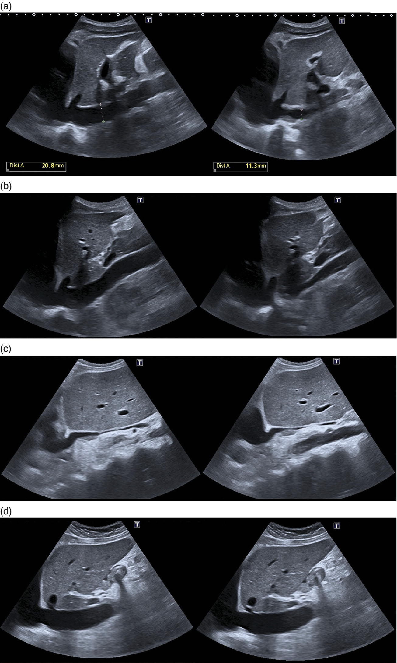 A set of four ultrasounds of a patient. A. Here the dist A is noted as 20.8 millimeters and 11.3 millimeters. B. A significant calibre reduction at inspiration. C. A sign of severe hypovolemia. D. A sign of severe pulmonary hypertension.