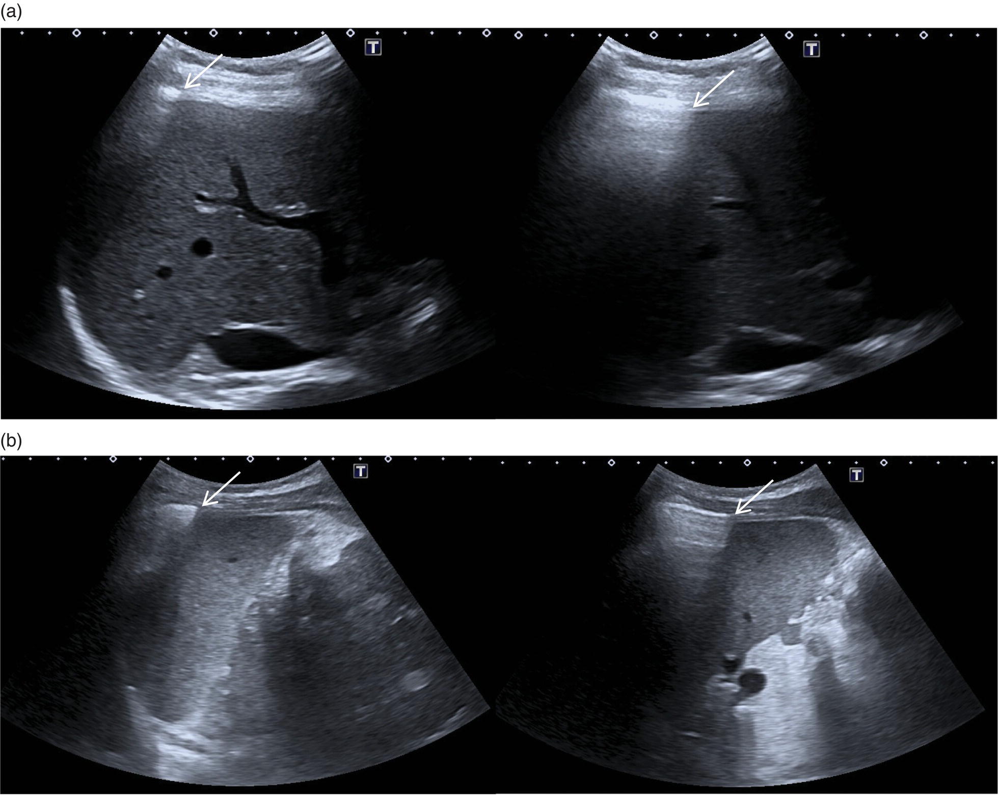 A set of two ultrasounds of a patient. A. Display of spleen. The arrow marks indicate the interface between the expanding ventilated lung and liver. B. Display of parenchyma.