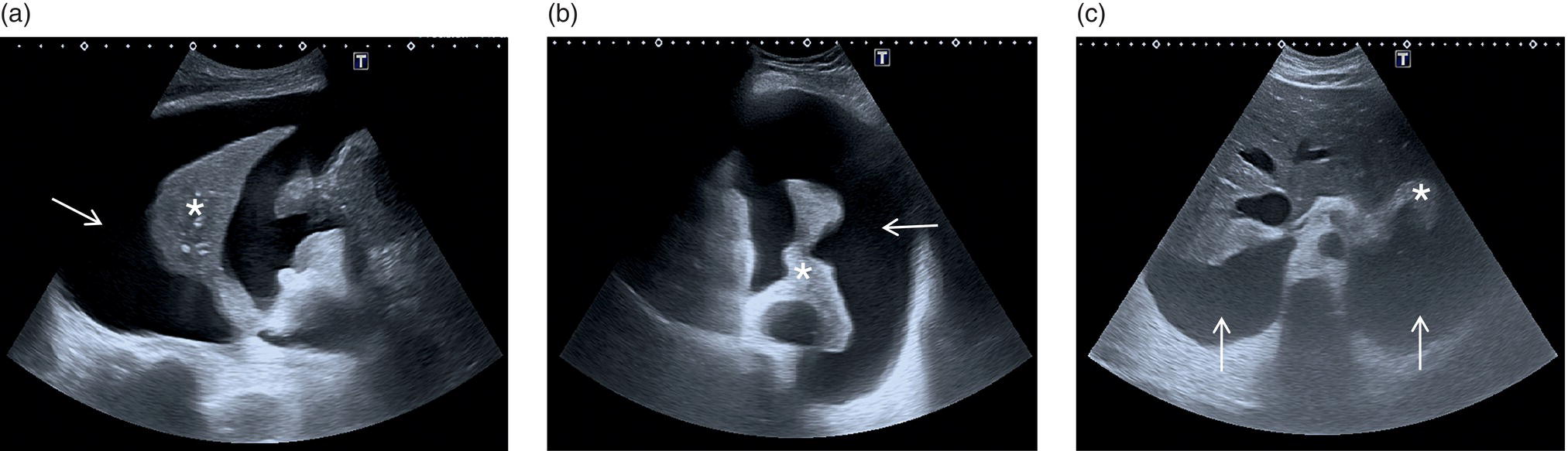 A set of three ultrasounds of a patient. A. The arrow mark denotes the right pleural effusion and the atelectasis of the right lung is denoted by an asterisk. B. Left pleural effusion. C. Bilateral pleural effusion.