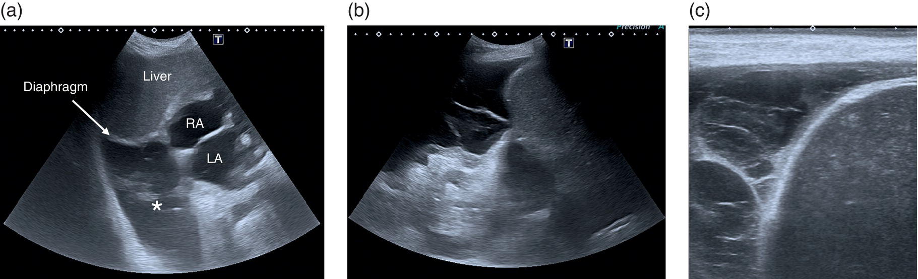 A set of three ultrasounds. A. Display of a large right pleural effusion denoted by asterik. B. Display of septations within effusion. C. Multiloculated pleural effusion. All are denoted by arrows.